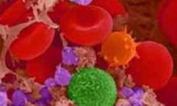 درمانی مؤثر برای نوعی خاص از سرطان خون درمانی مؤثر برای نوعی خاص از سرطان خون